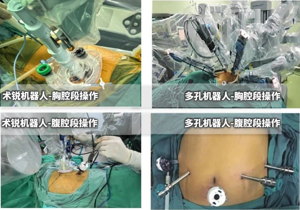 郑大一附院成功完成 12 例蛇形臂单孔机器人辅助食管癌根治术 —— 开创食管癌微创新纪元